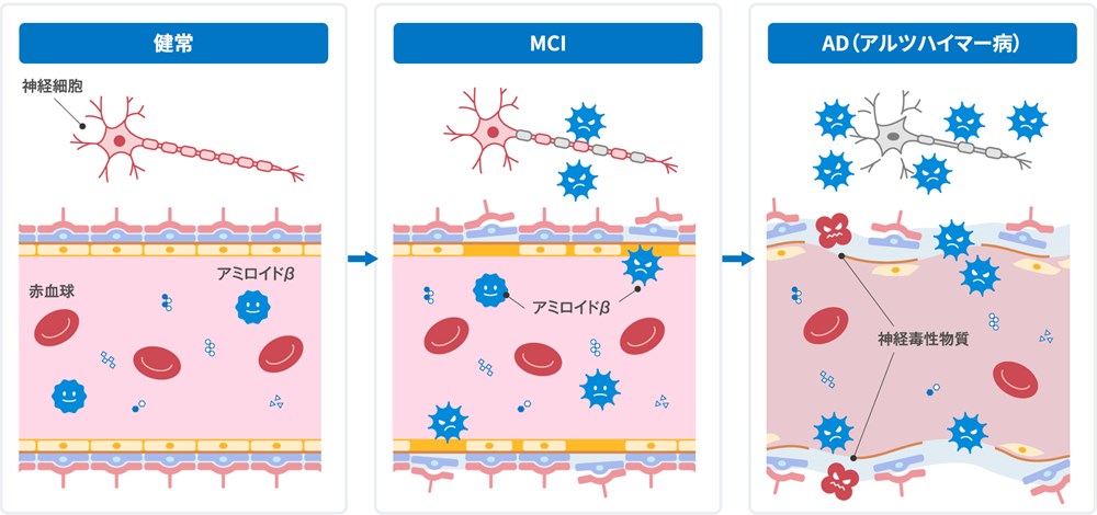 MCIスクリーニング検査プラスのメカニズム